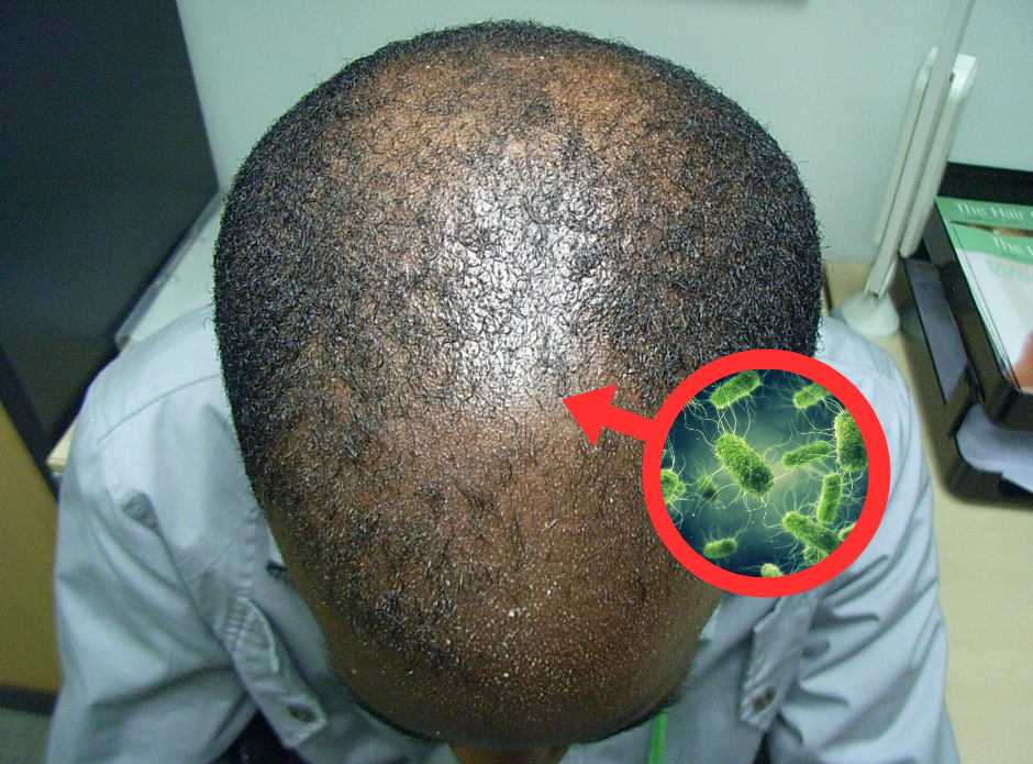Black man's crown showing thinning pattern