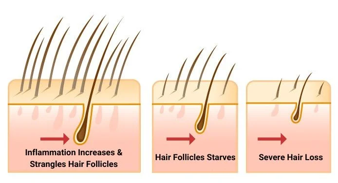 How compression thinning damages hair follicles