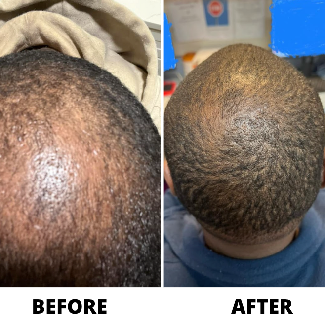 Before and after crown filling in